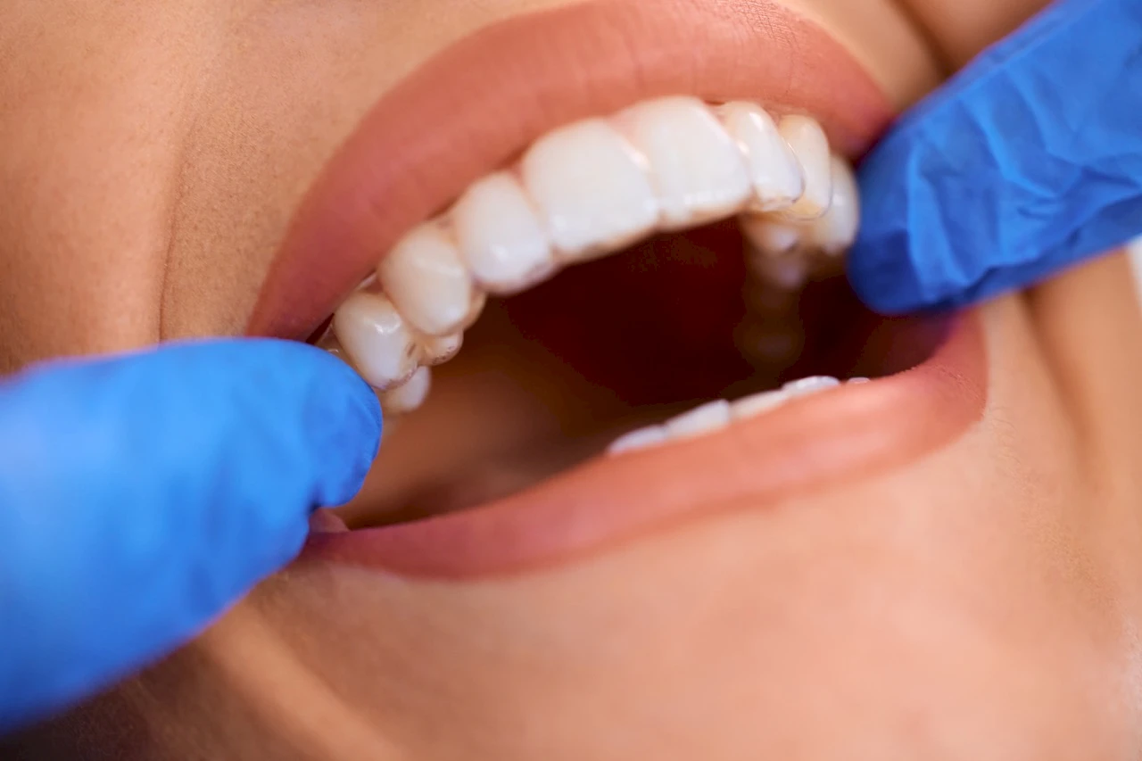 Çini kaplamalarla parlaq bir təbəssüm əldə edin: Türkiyənin ağ dişinə dair tam bələdçi